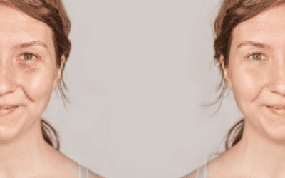 IV Glutathione and its Skin Health Properties